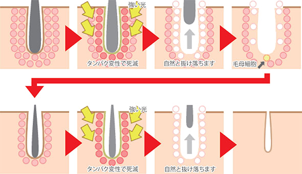 光脱毛の仕組み